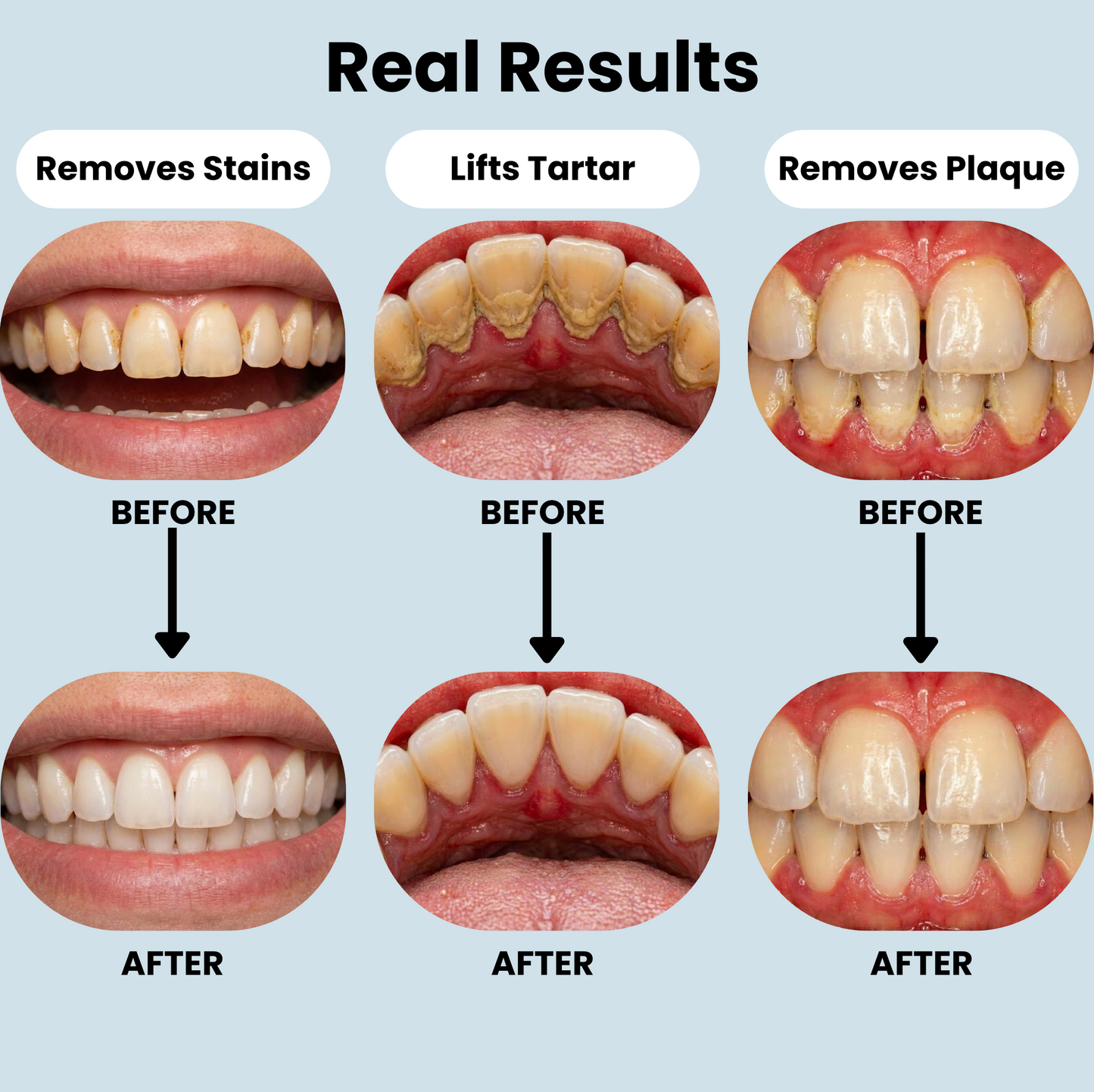 The AloSmile Tooth Cleaner